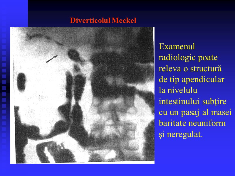 Diverticolul Meckel Examenul radiologic poate releva o structură de tip apendicular la nivelulu intestinului